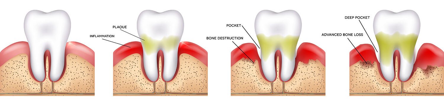Gingiile și parodontoza