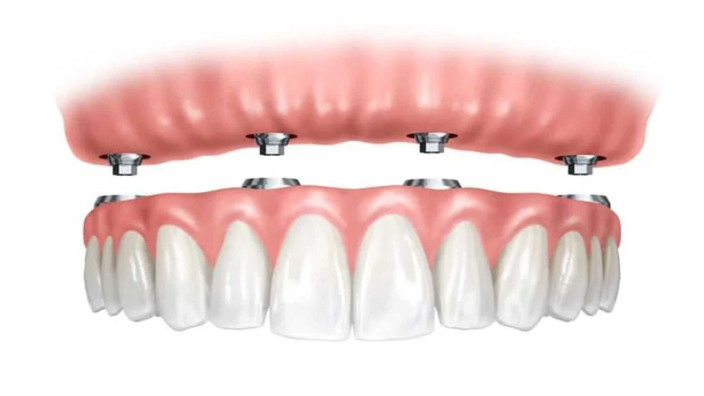 Proteze dentare complete