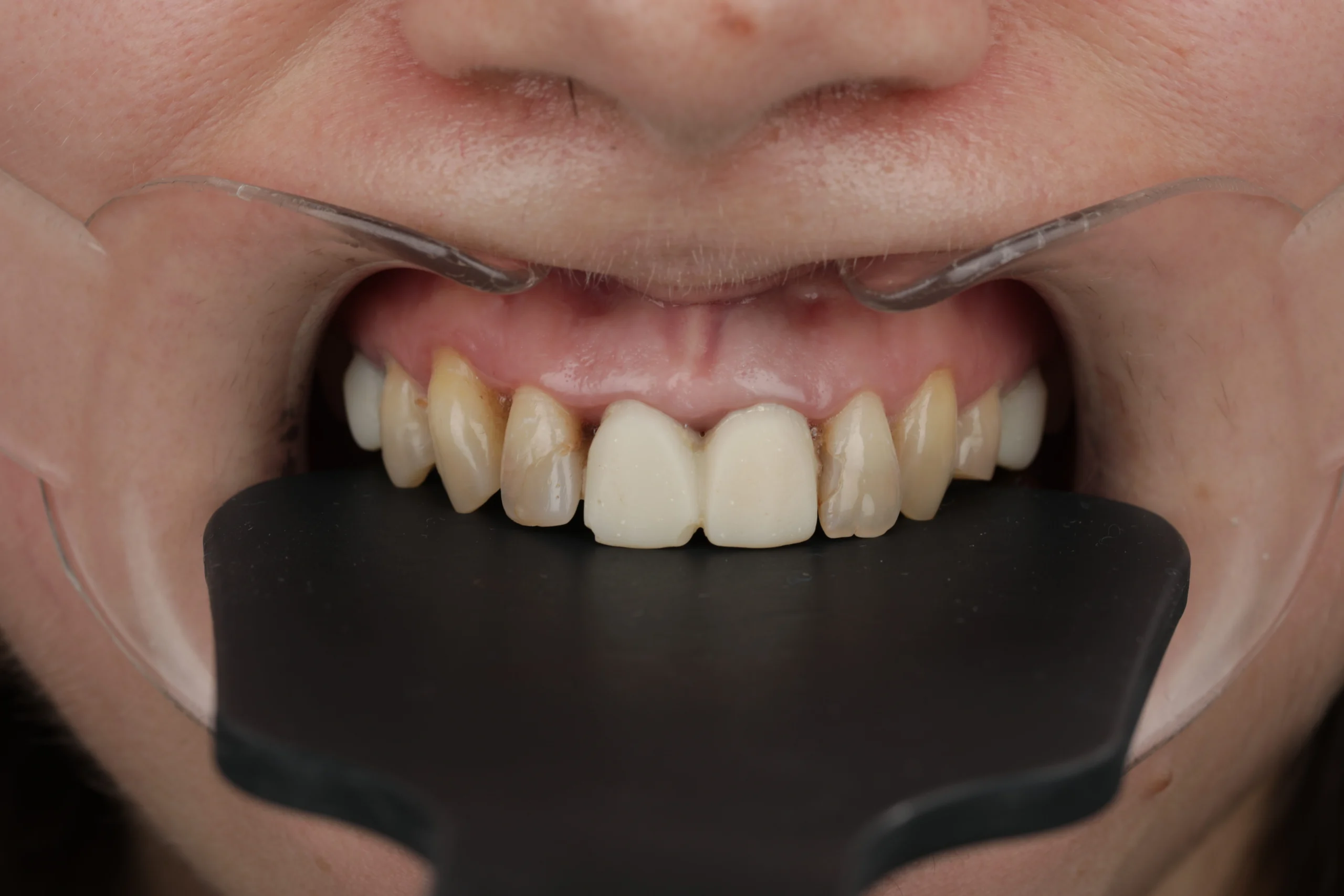 Caz clinic – înainte