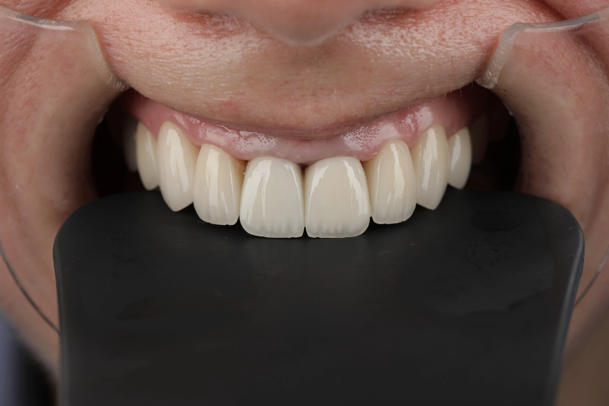 Caz clinic – după