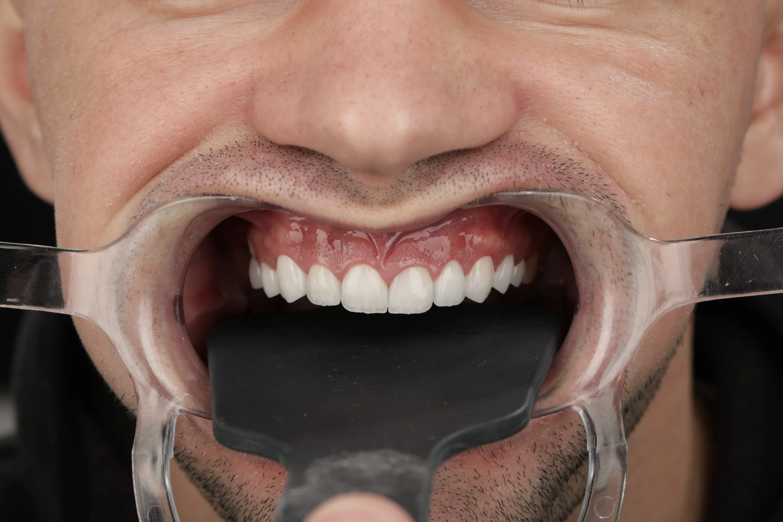 Caz clinic – după