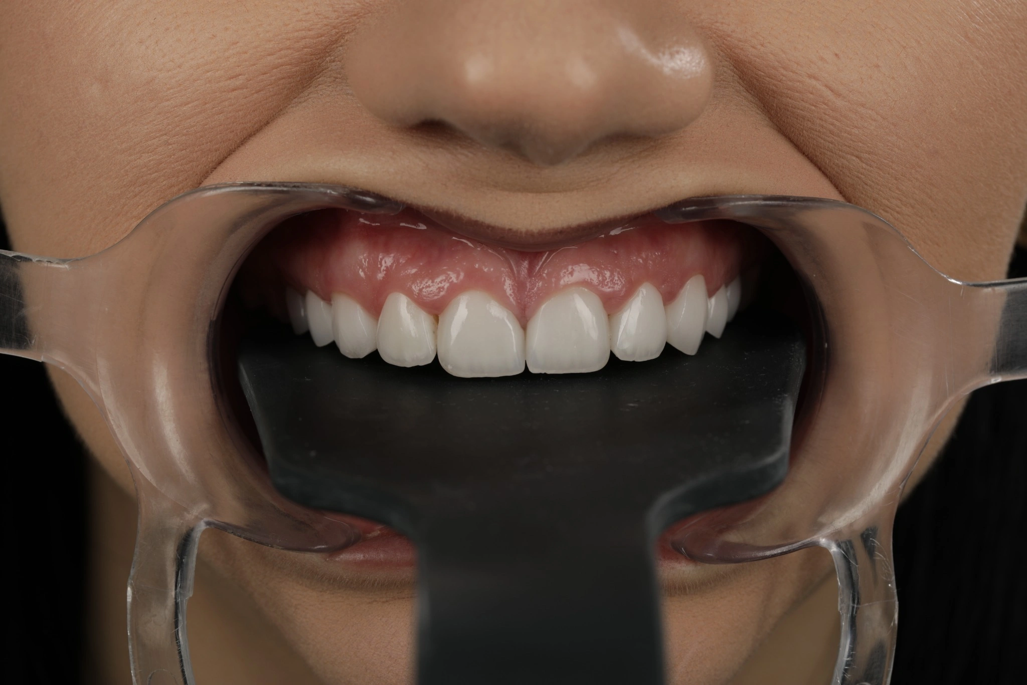 Caz clinic – după