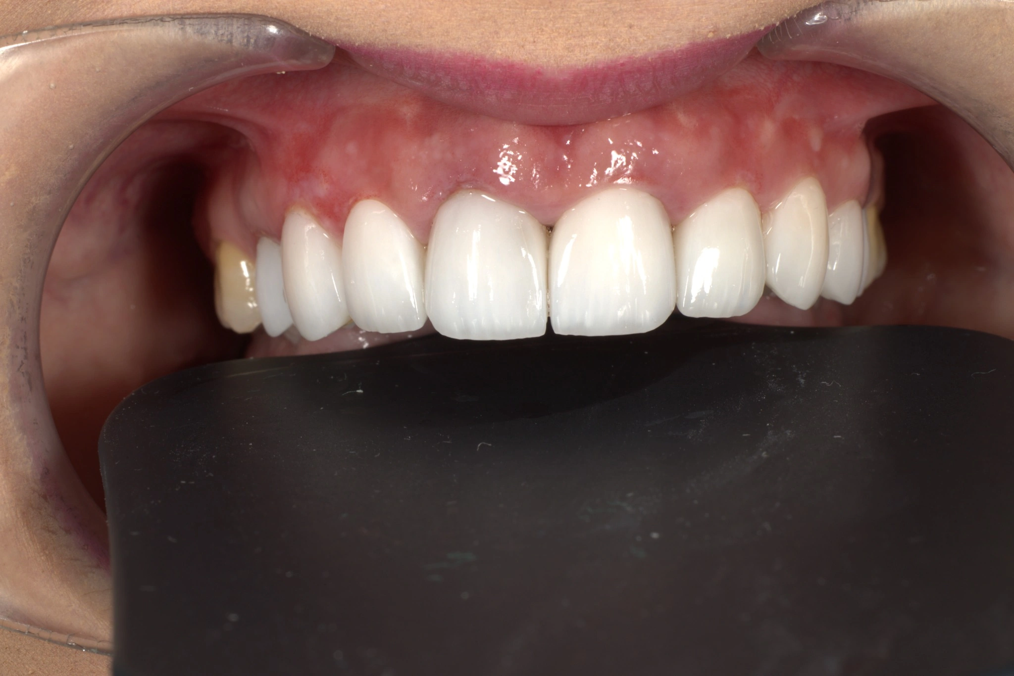 Caz clinic – după