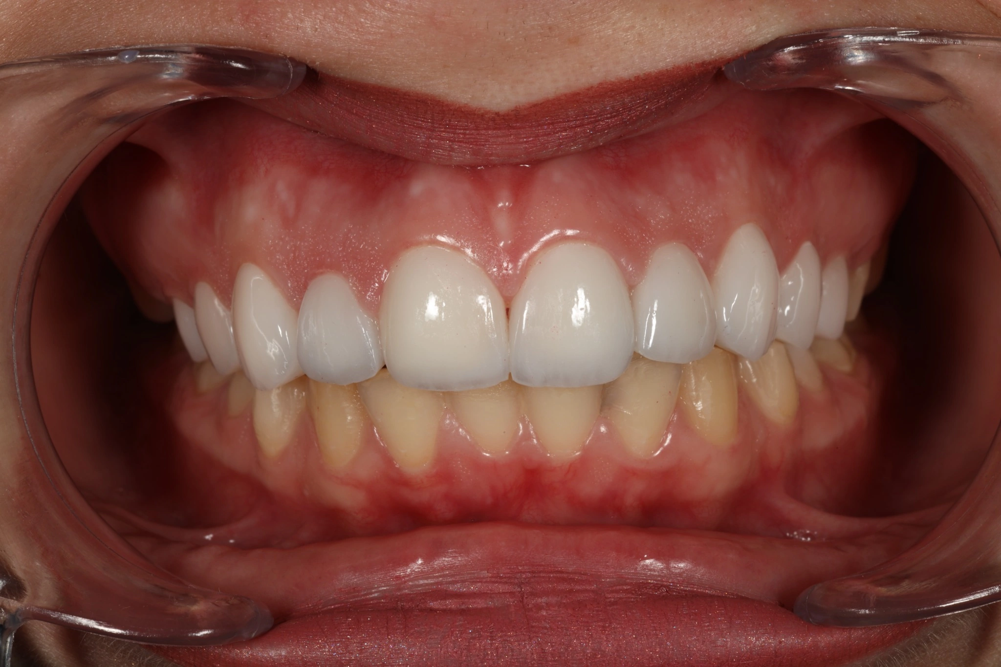 Caz clinic – după